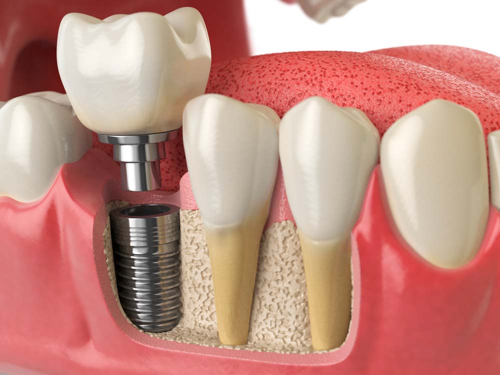 Imatge - Implant dental