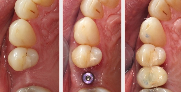 Imatge - Implant dental
